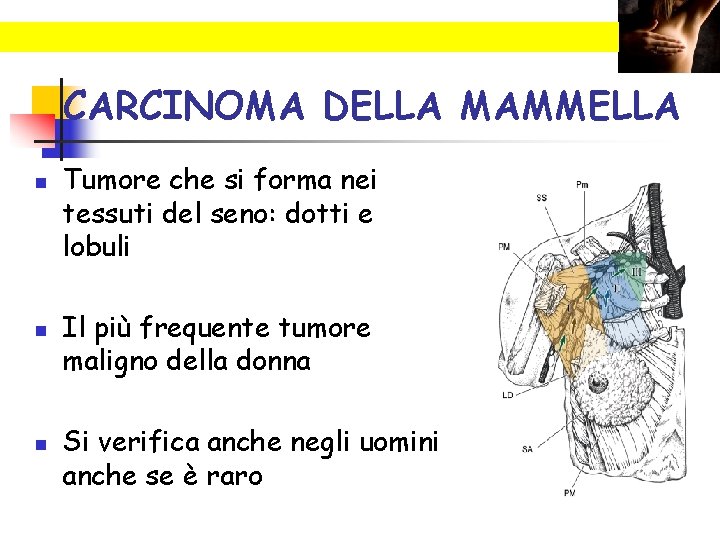 CARCINOMA DELLA MAMMELLA n n n Tumore che si forma nei tessuti del seno: