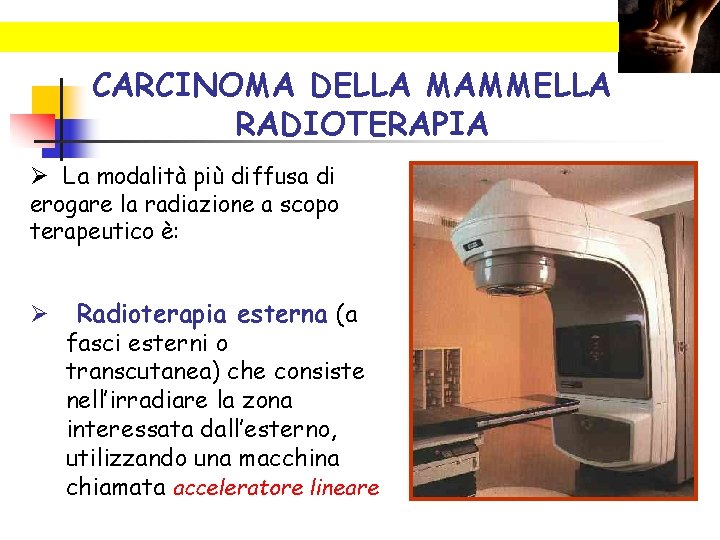 CARCINOMA DELLA MAMMELLA RADIOTERAPIA Ø La modalità più diffusa di erogare la radiazione a