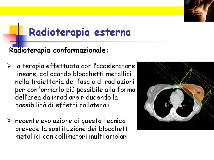 Radioterapia esterna Radioterapia conformazionale: Ø la terapia effettuata con l’acceleratore lineare, collocando blocchetti metallici