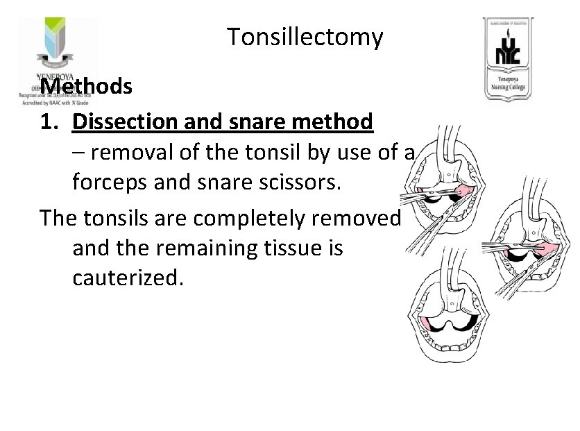 Tonsillectomy Methods 1. Dissection and snare method – removal of the tonsil by use