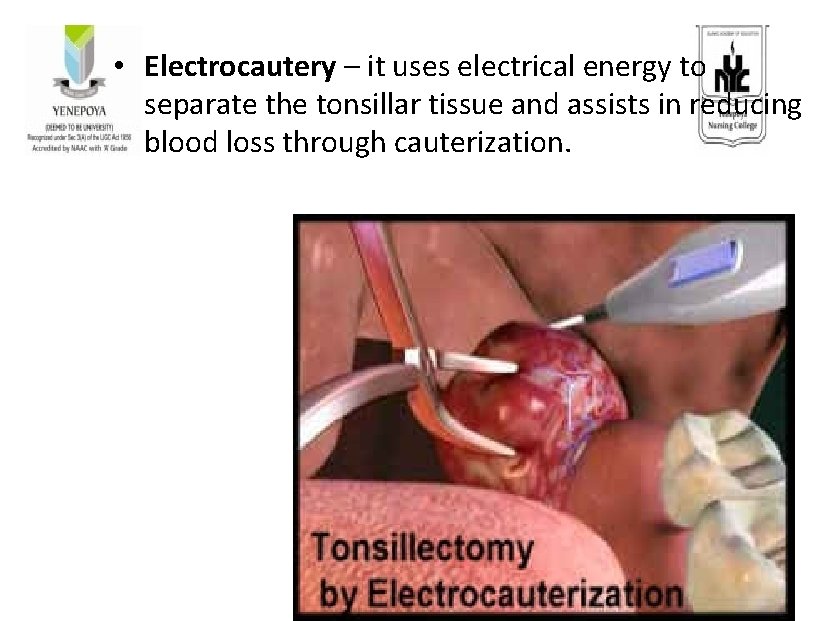  • Electrocautery – it uses electrical energy to separate the tonsillar tissue and