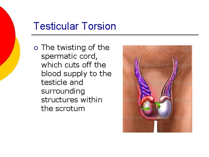 Testicular Torsion ¡ The twisting of the spermatic cord, which cuts off the blood
