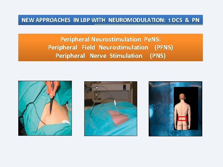 NEW APPROACHES IN LBP WITH NEUROMODULATION: t DCS & PN Peripheral Neurostimulation Pe. NS: