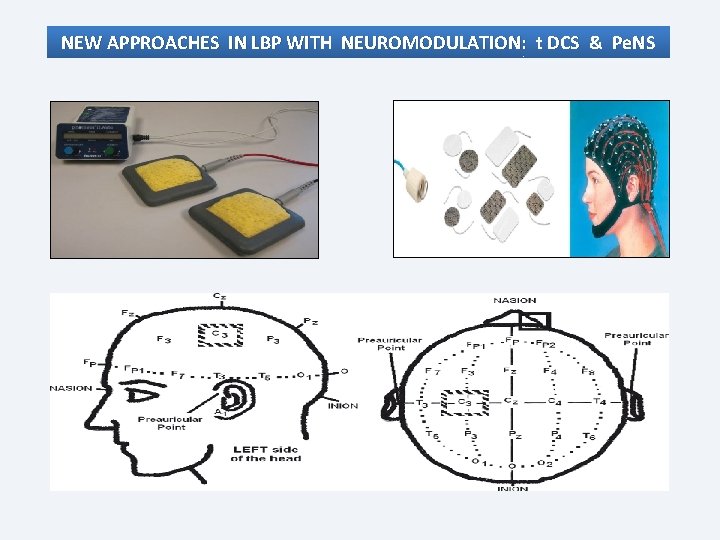 NEW APPROACHES IN LBP WITH NEUROMODULATION: t DCS & Pe. NS 