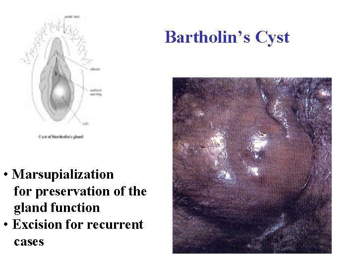 Bartholin’s Cyst • Marsupialization for preservation of the gland function • Excision for recurrent