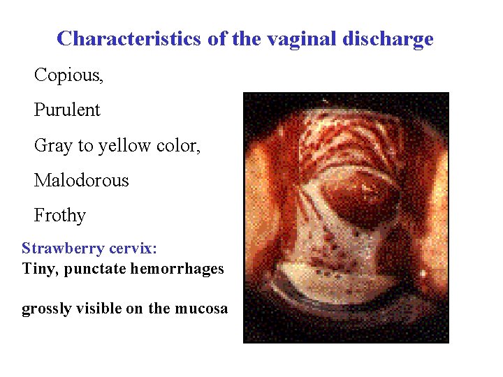  Characteristics of the vaginal discharge Copious, Purulent Gray to yellow color, Malodorous Frothy