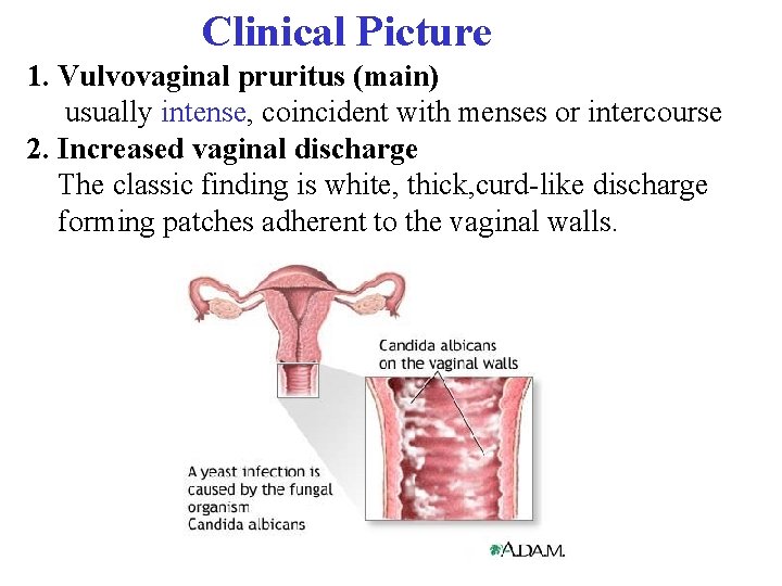  Clinical Picture 1. Vulvovaginal pruritus (main) usually intense, coincident with menses or intercourse