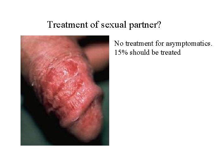 Treatment of sexual partner? No treatment for asymptomatics. 15% should be treated 