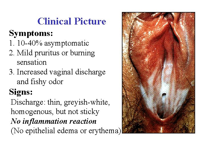  Clinical Picture Symptoms: 1. 10 -40% asymptomatic 2. Mild pruritus or burning sensation