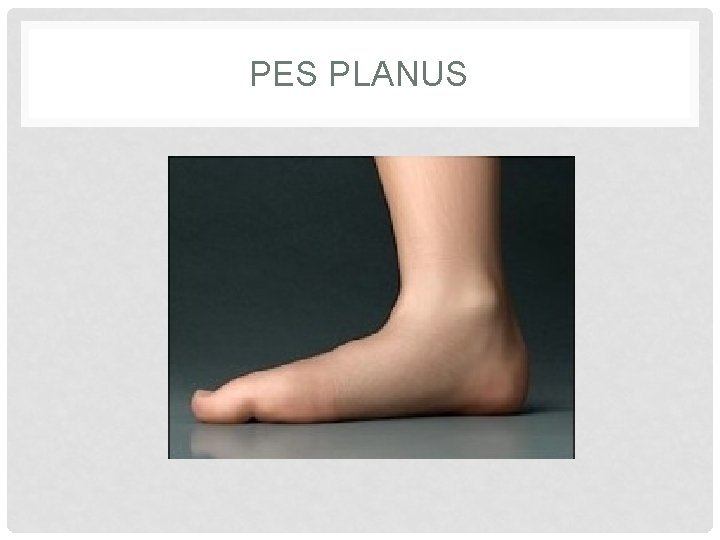 PES PLANUS 