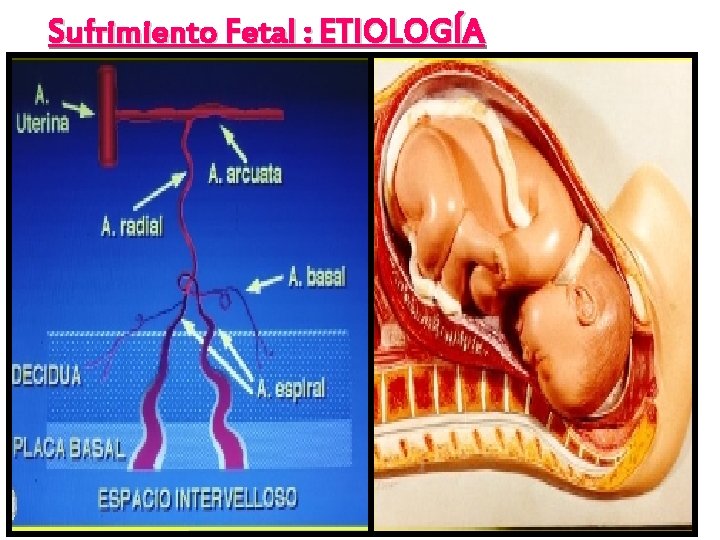 Sufrimiento Fetal : ETIOLOGÍA 