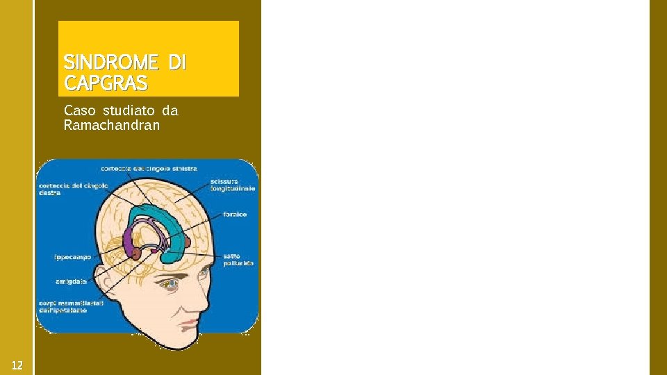 SINDROME DI CAPGRAS Caso studiato da Ramachandran 12 