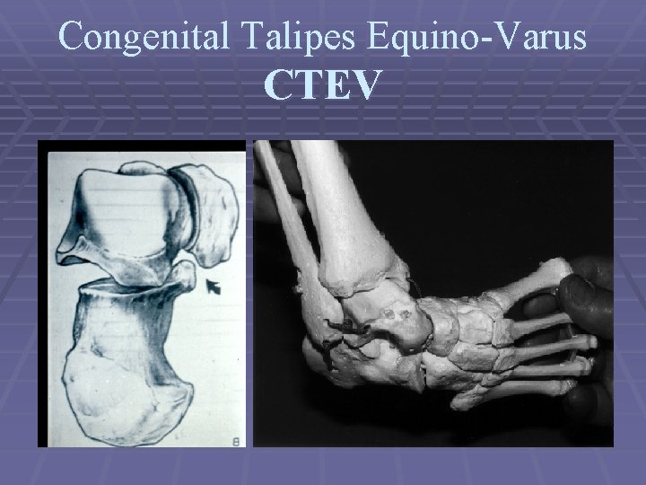 Congenital Talipes Equino-Varus CTEV 