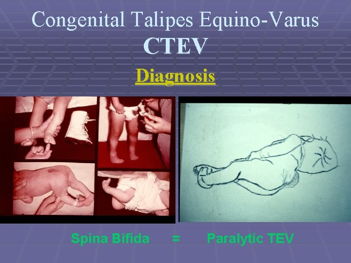 Congenital Talipes Equino-Varus CTEV Diagnosis Spina Bifida = Paralytic TEV 