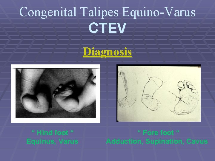 Congenital Talipes Equino-Varus CTEV Diagnosis “ Hind foot “ “ Fore foot “ Equinus,