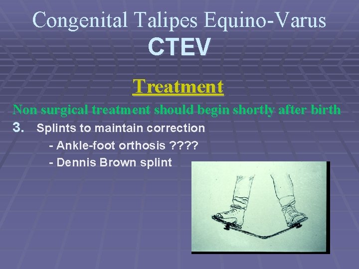 Congenital Talipes Equino-Varus CTEV Treatment Non surgical treatment should begin shortly after birth 3.