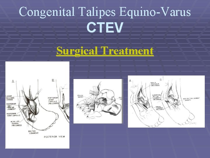 Congenital Talipes Equino-Varus CTEV Surgical Treatment 