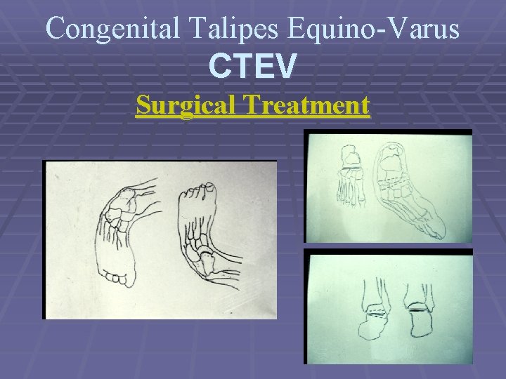 Congenital Talipes Equino-Varus CTEV Surgical Treatment 