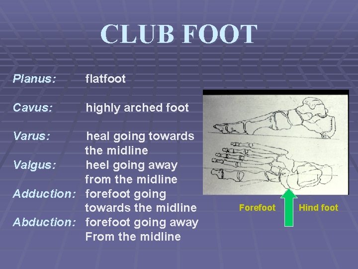 CLUB FOOT Planus: flatfoot Cavus: highly arched foot Varus: heal going towards the midline