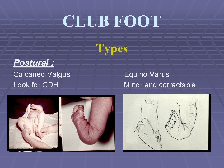 CLUB FOOT Types Postural : Calcaneo-Valgus Look for CDH Equino-Varus Minor and correctable 