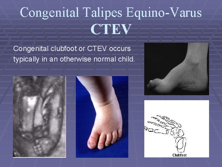 Congenital Talipes Equino-Varus CTEV Congenital clubfoot or CTEV occurs typically in an otherwise normal