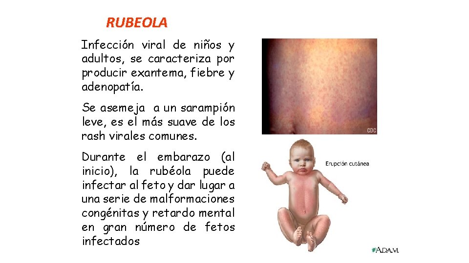 RUBEOLA Infección viral de niños y adultos, se caracteriza por producir exantema, fiebre y