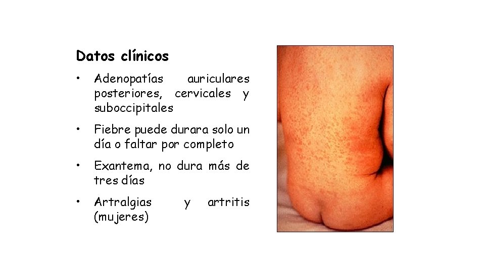 Datos clínicos • Adenopatías auriculares posteriores, cervicales y suboccipitales • Fiebre puede durara solo