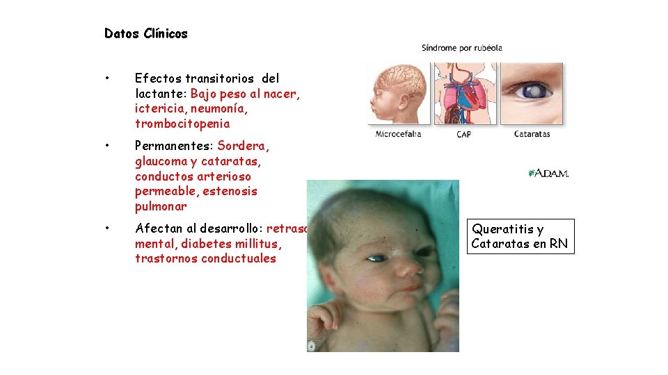Datos Clínicos • Efectos transitorios del lactante: Bajo peso al nacer, ictericia, neumonía, trombocitopenia
