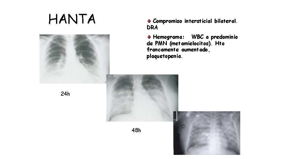 HANTA Compromiso intersticial bilateral. DRA Hemograma: WBC a predominio de PMN (metamielocitos). Hto francamente