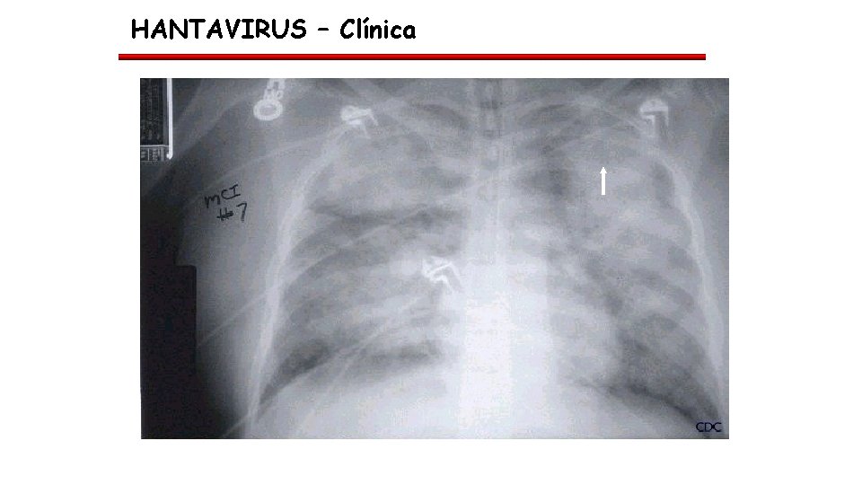 HANTAVIRUS – Clínica 