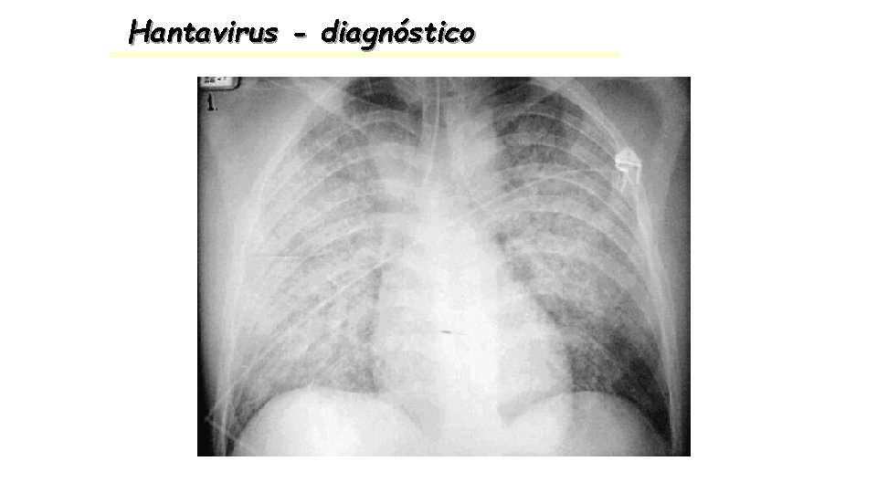 Hantavirus - diagnóstico 