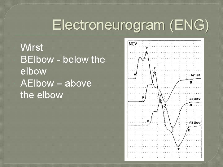 Electroneurogram (ENG) Wirst BElbow - below the elbow AElbow – above the elbow Electroneurogram (ENG) Wirst BElbow - below the elbow AElbow – above the elbow