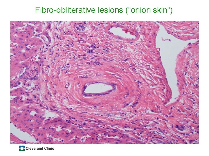 Fibro-obliterative lesions (“onion skin”) 