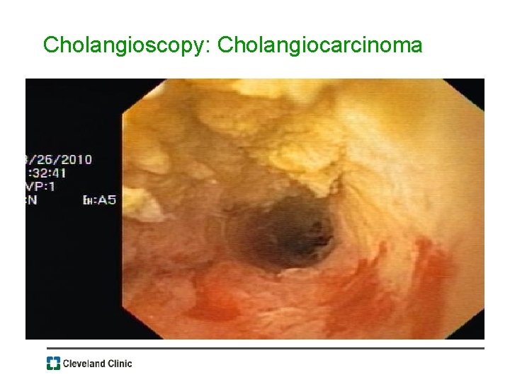 Cholangioscopy: Cholangiocarcinoma 