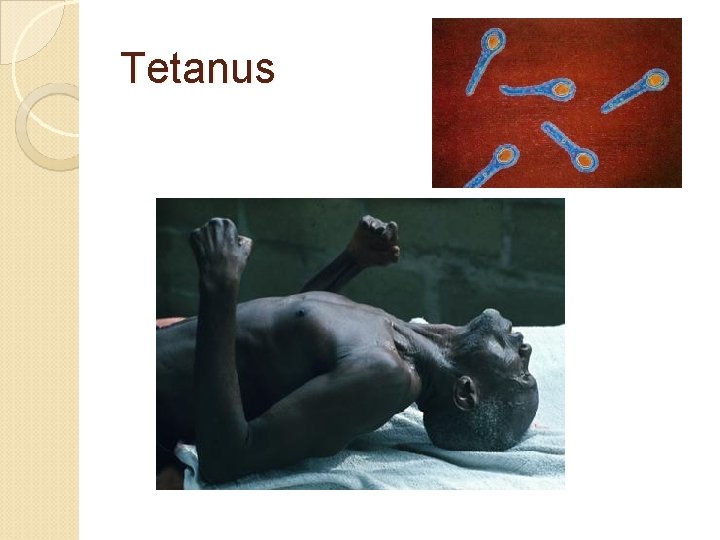 Tetanus 