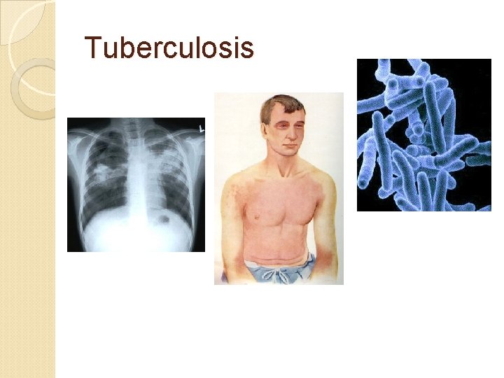 Tuberculosis 