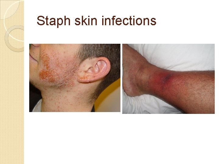 Staph skin infections 