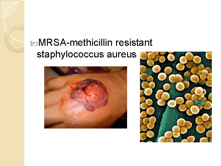  MRSA-methicillin resistant staphylococcus aureus 