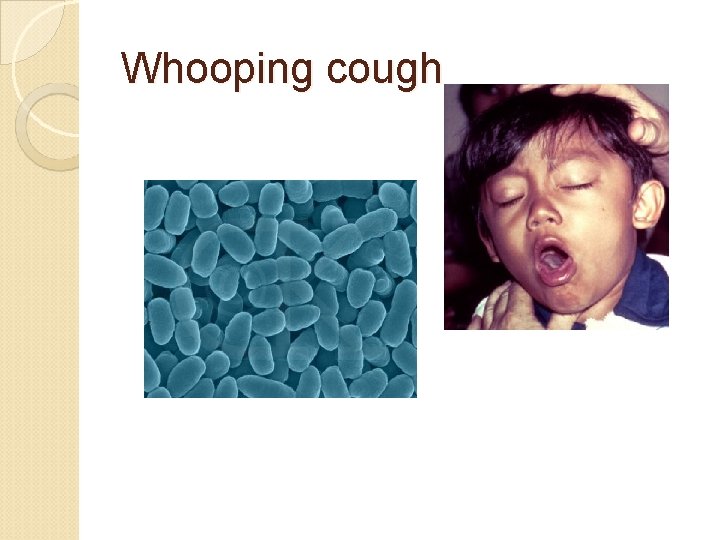 Whooping cough 