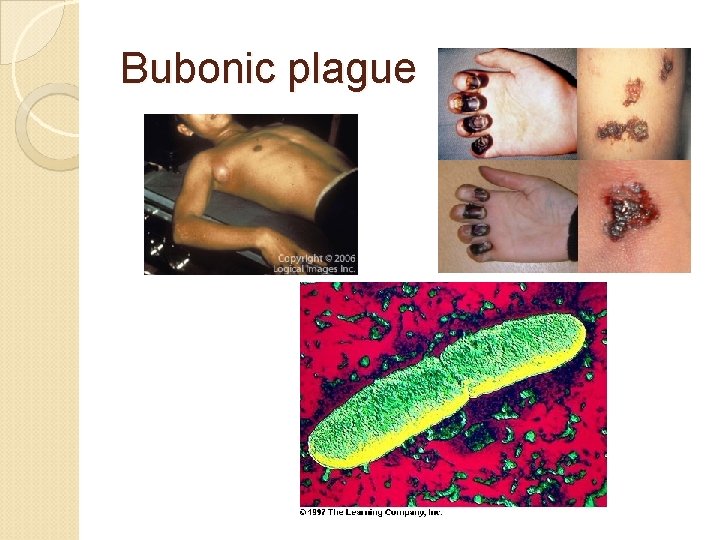 Bubonic plague 