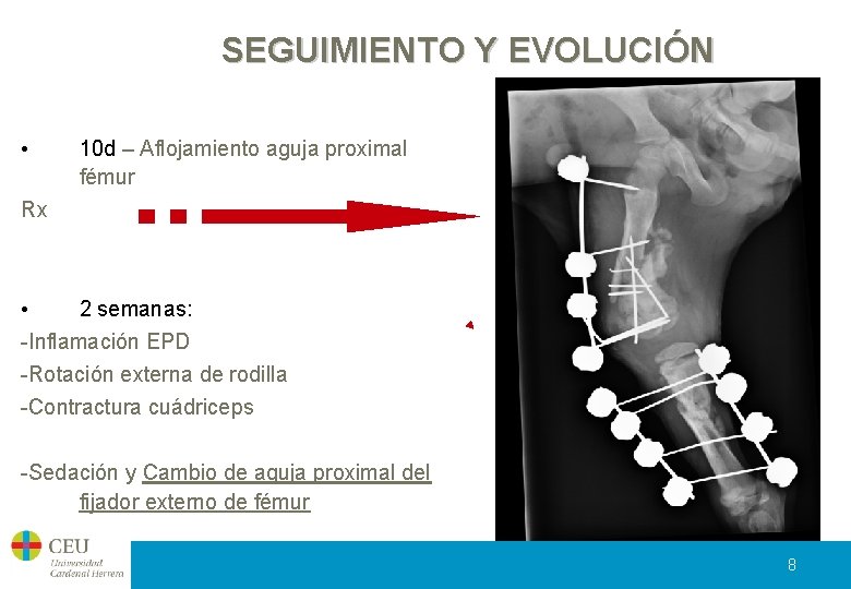 SEGUIMIENTO Y EVOLUCIÓN • 10 d – Aflojamiento aguja proximal fémur Rx • 2