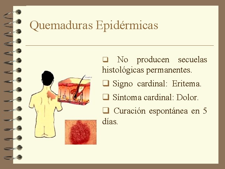 Quemaduras Epidérmicas No producen secuelas histológicas permanentes. q q Signo cardinal: Eritema. q Síntoma