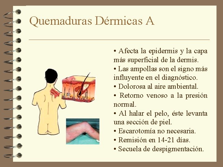 Quemaduras Dérmicas A • Afecta la epidermis y la capa más superficial de la