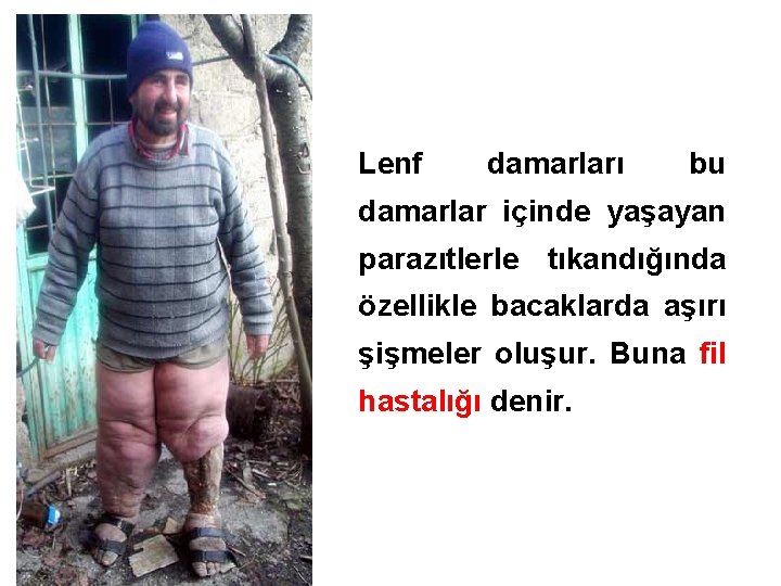 Lenf damarları bu damarlar içinde yaşayan parazıtlerle tıkandığında özellikle bacaklarda aşırı şişmeler oluşur. Buna