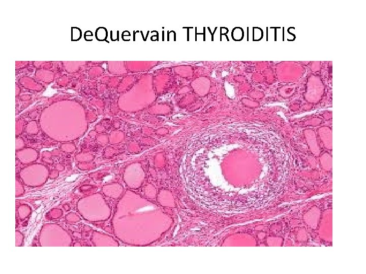 De. Quervain THYROIDITIS 