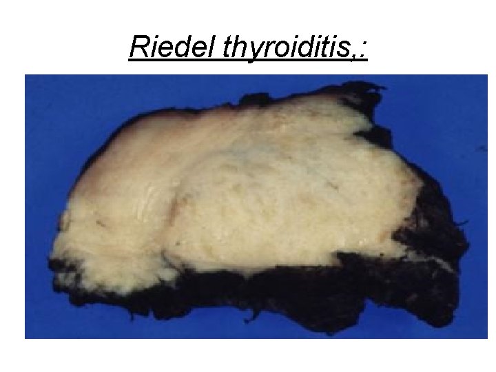 Riedel thyroiditis, : 