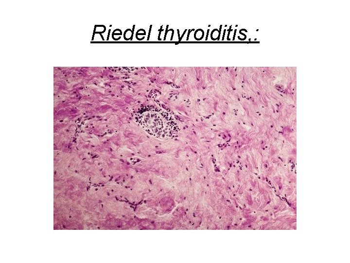 Riedel thyroiditis, : 