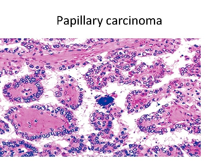 Papillary carcinoma 