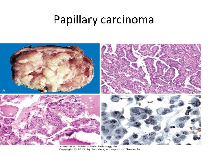 Papillary carcinoma 