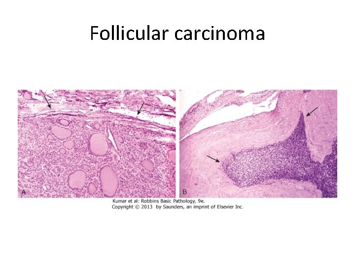 Follicular carcinoma 